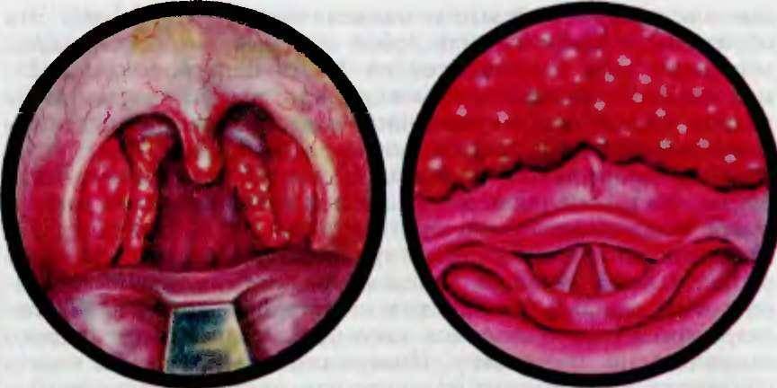 Язвенно-пленчатая ангина симановского-плаута-венсана