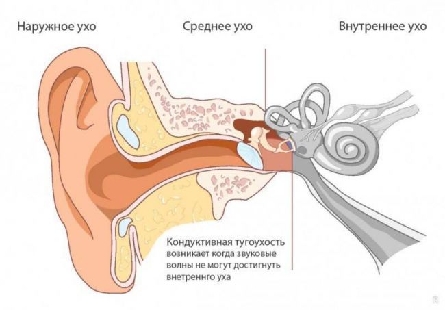 Отит — что это такое, виды, симптомы у взрослых, лечение отита уха