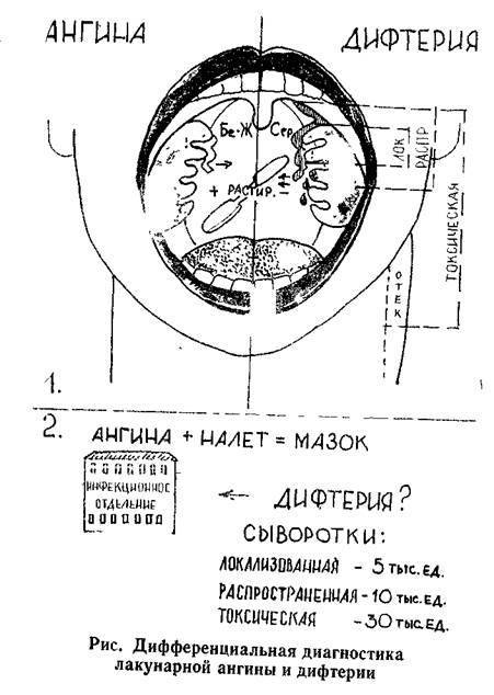 Язвенно-пленчатая ангина симановского-плаута-венсана - симптомы болезни, профилактика и лечение язвенно-пленчатой ангины симановского-плаута-венсана, причины заболевания и его диагностика на eurolab