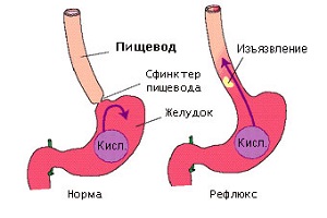 Жжение и неприятные ощущения во рту и на языке причины и лечение