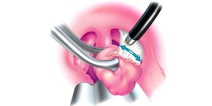 Когда можно чистить зубы после удаления миндалин