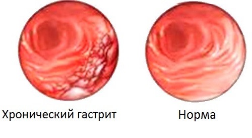 Что такое бульбит желудка и как его вылечить