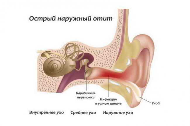 Симптомы и лечение воспаления внутреннего уха у взрослых и детей