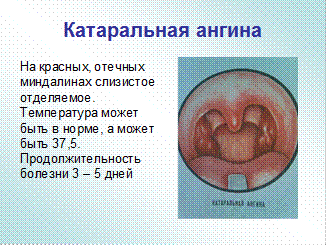Ангина симановского-плаута-венсана: симптомы и лечение