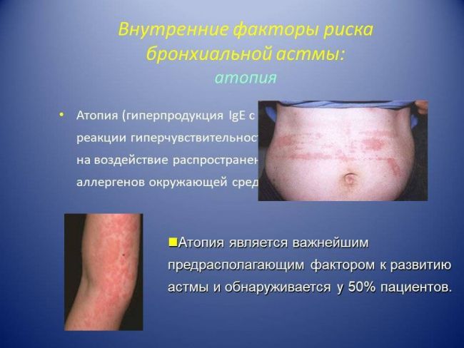 Особенности ступенчатого лечения бронхиальной астмы у взрослых и детей