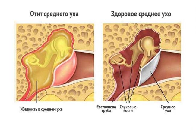 Причины и симптомы отита, как его лечить?