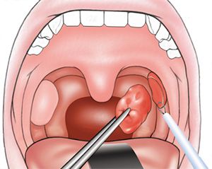 Диета при тонзиллэктомии. питание после тонзиллэктомии, какое и сколько придерживаться такого режима?