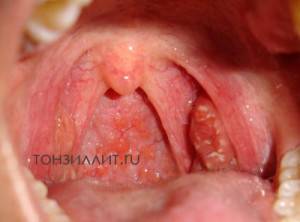 Ангина симановского-плаута-венсана