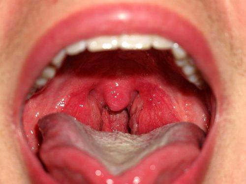 Некротическая ангина