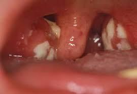 Некротическая ангина