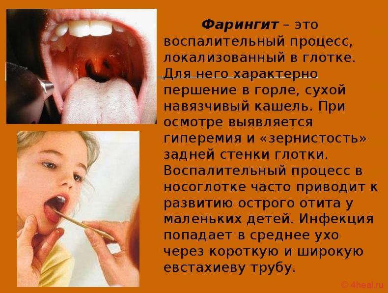 Фарингит