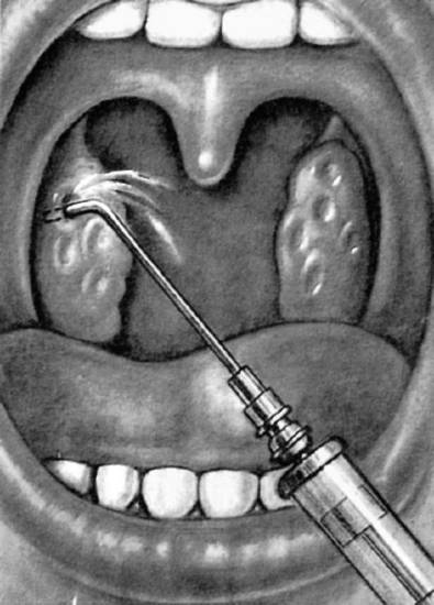Как проявляется и лечится ангина симановского-венсана