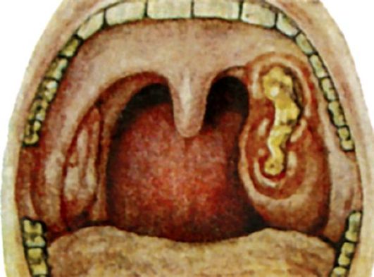 Некротическая ангина