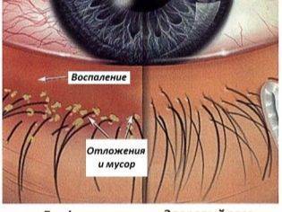 Тетрациклиновая мазь при ячмене