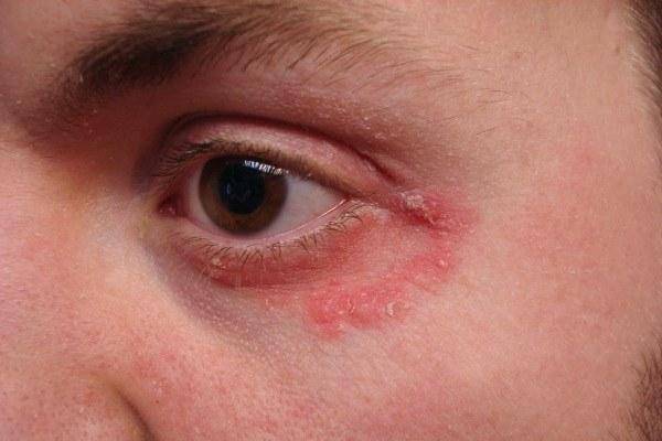 Аллергия глаза чешутся и опухают веки