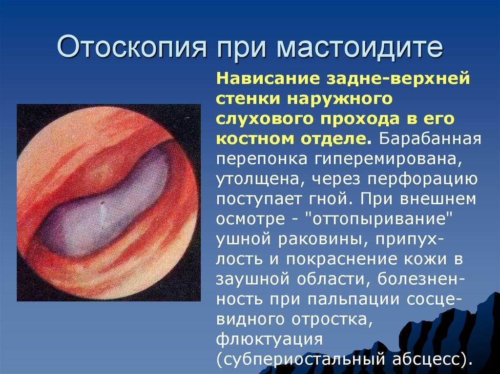 Мастоидит: развитие, симптоматика и течение, лечение хронического и острого