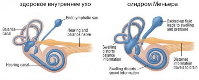 Причины, симптомы и лечение воспаления среднего уха