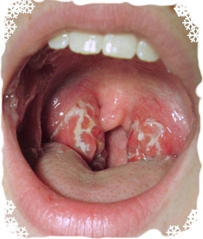 Ангина симановского-плаута-венсана