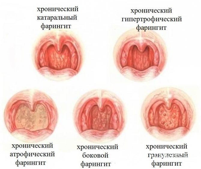 Хронический фарингит