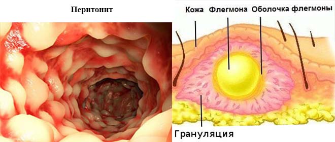 Почему развивается асцит, как его распознать и вылечить