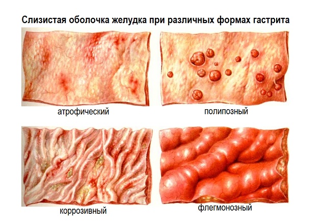 Правильная диета при бульбите и гастрите