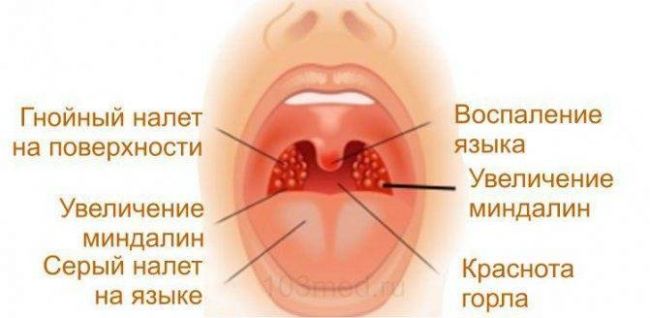 Список антибиотиков при фарингите для взрослых и детей