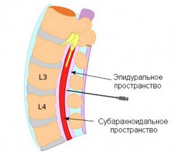 Спинальная анестезия - отзывы