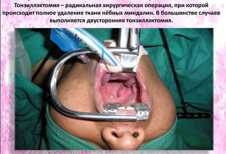 Удаление гланд у взрослых: методы проведения операции, реабилитация и последствия