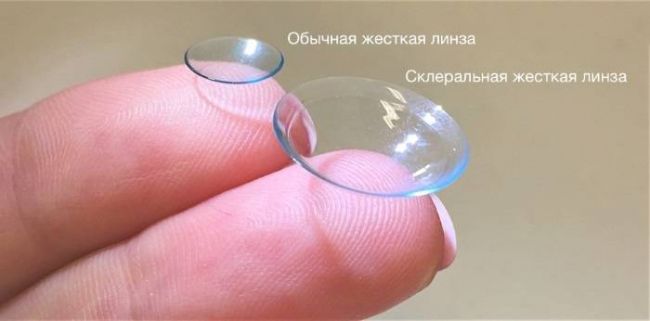 Как лечить кератоконус народными средствами