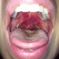 Реабилитация после тонзиллэктомии: что можно есть, сколько болит горло, лечение