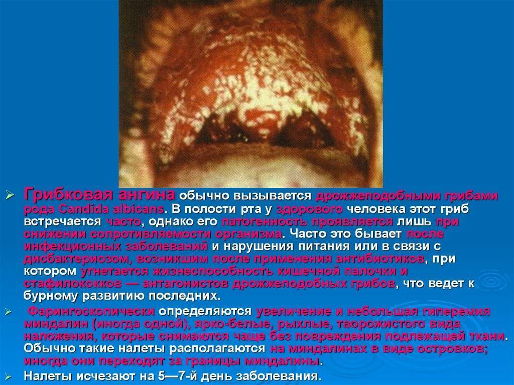 Язвенно-пленчатая ангина симановского-плаута-венсана