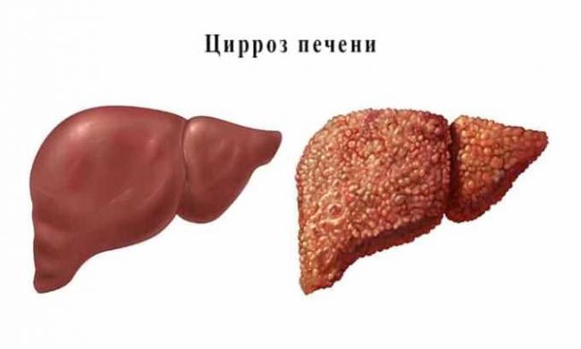 Как лечить заболевания щитовидной железы средством левокарнитин?