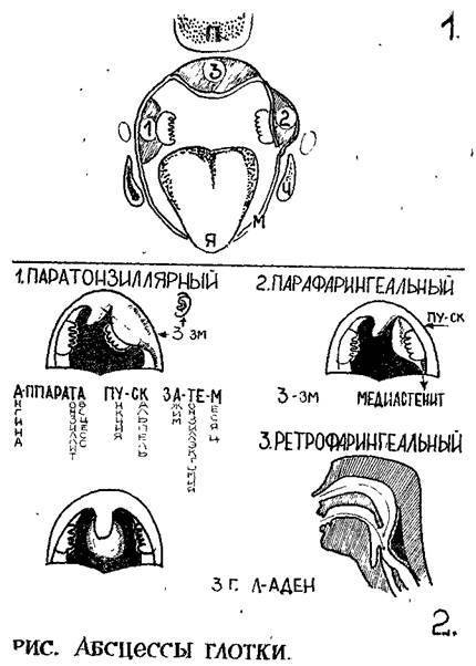 Ангина венсана симановского