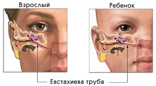 Заложены уши при простуде: как снять заложенность? методы лечения