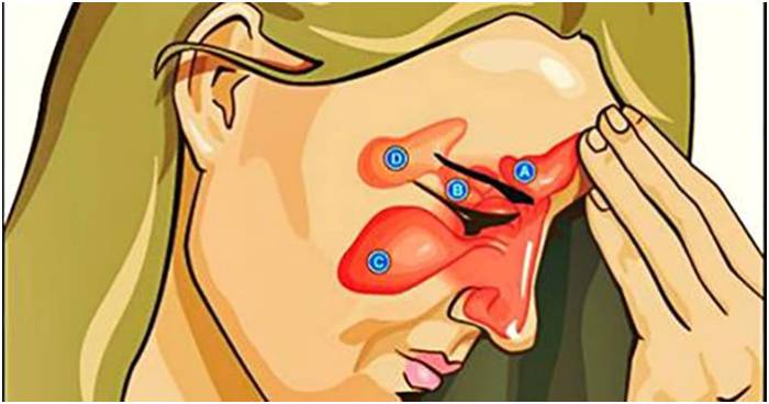 Лечение гнойного ринита, вонючих выделений и соплей с гноем