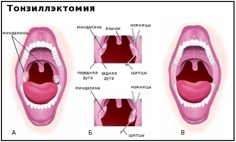 Тонзиллэктомия диета. что можно кушать после удаления гланд