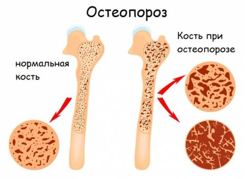 Алендроновая кислота: показания, инструкция по применению, состав, дозировка, отзывы