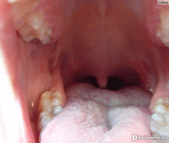 Удаление миндалин, тонзиллэктомия: операция, после и до