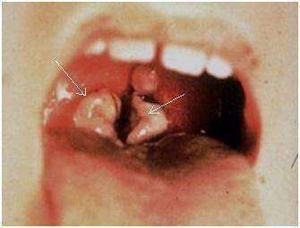 Ангина симановского-плаута-венсана