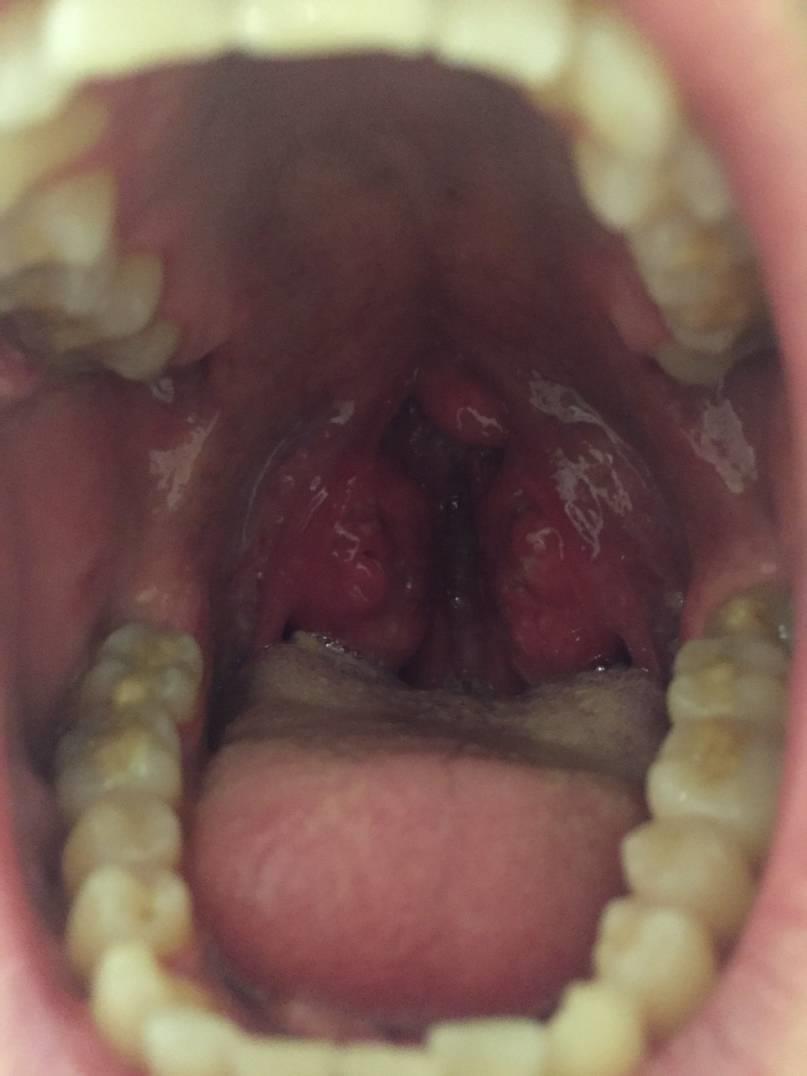 Ангина симановского-плаута-венсана: симптомы и лечение