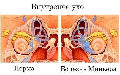 Воспаление уха: чем лечить. причины и симптомы воспаления уха
