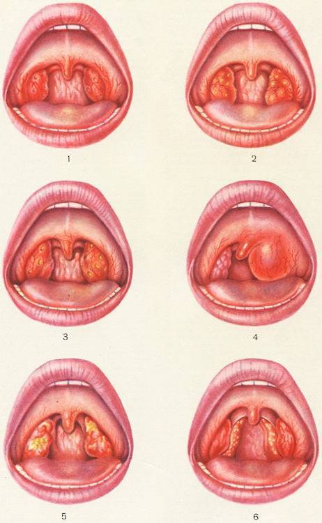 Некротическая ангина
