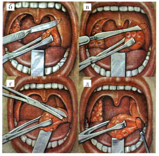 Когда можно чистить зубы после удаления миндалин