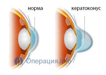 Как лечить кератоконус народными средствами