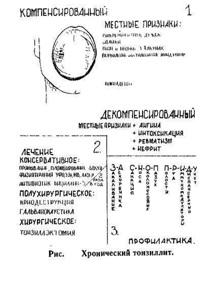 Ангина без температуры, или язвенно некротическая ангина венсана – плаута – симановского