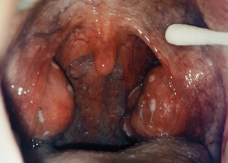 Удаление миндалин: показания, проведение вмешательства, послеоперационный период