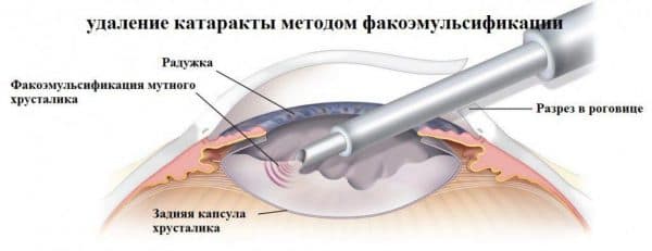 Как долго восстанавливается зрение после удаления катаракты