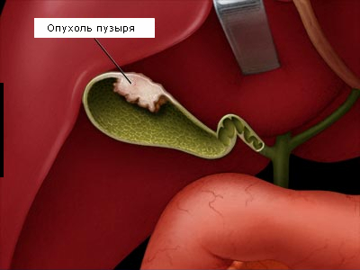 Полип желчного пузыря. причины, симптомы, диагностика, лечение и профилактика