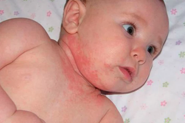 Аллергический дерматит