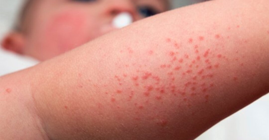 Аллергический дерматит у взрослых